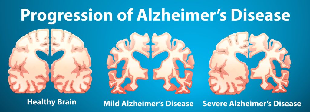 Alzheimers, Den Dødelige Demens Sygdom - Sundhedsfagligblog.dk